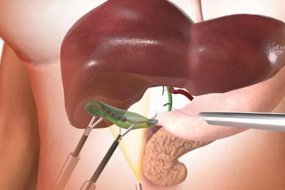 Colecistectomía de mínima invasión