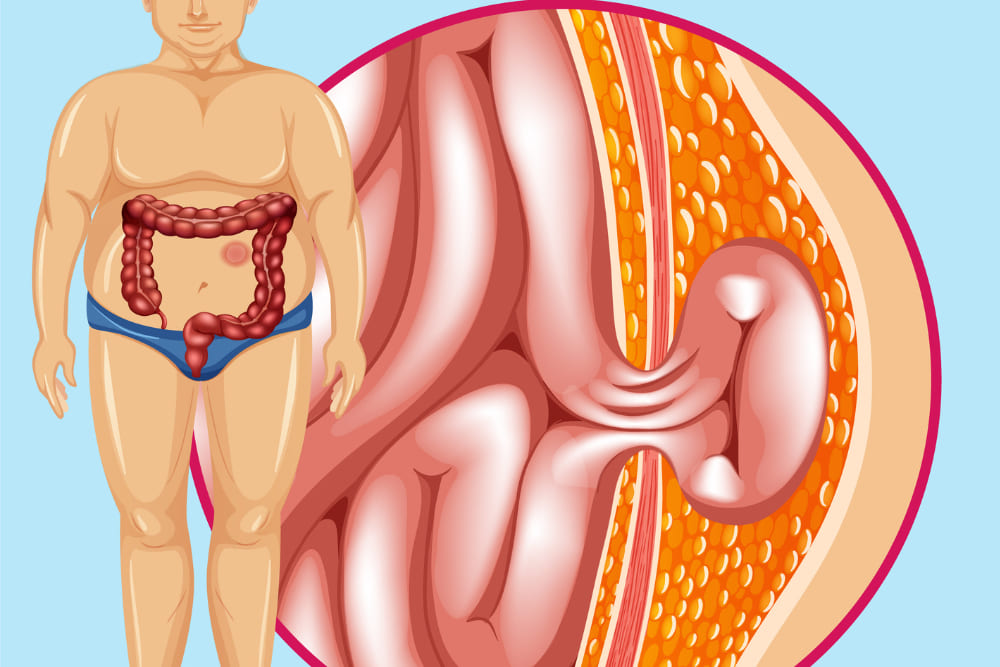 Corrección estructural de hernias