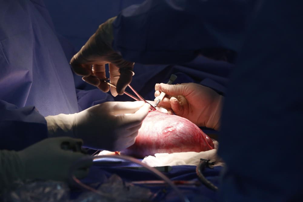 Trasplante hepático de alta complejidad